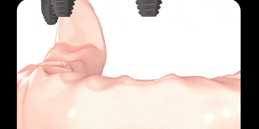 디지털아트치과 전체임플란트