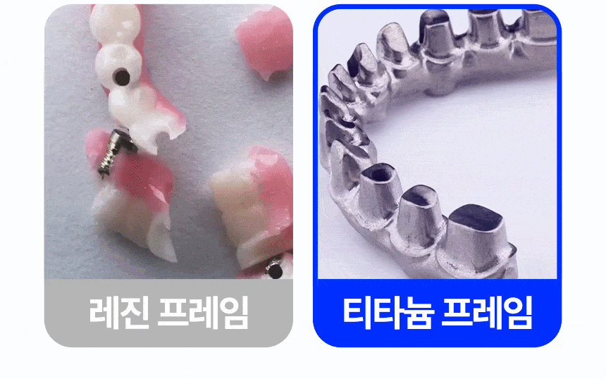 디지털아트치과 전체임플란트